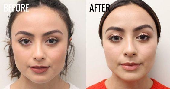 masseter botox before and after