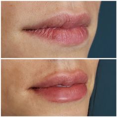 lip fillers before and after picture